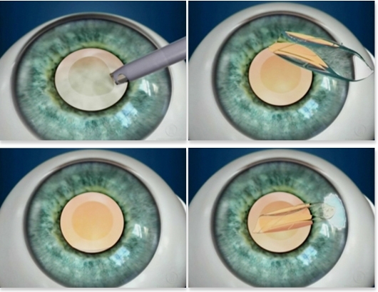 Oftalnova_oftalmolohoa_barcelona_solucion_cataratas_proceso