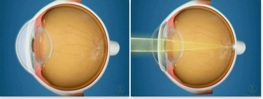 Oftalnova_oftalmologia_Barcelona_patologias_cornea
