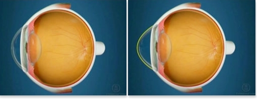 Oftalnova_oftalmologia_Barcelona_Queratocono