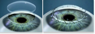 Oftalnova_Oftalmologia_Barcelona_Solucion_para_Queratocono