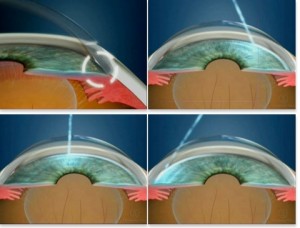 Oftalnova_oftalmologia_Barcelona_Tratamientos_Glaucoma-300x228