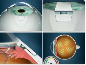 Oftalnova_oftalmologia_Barcelona_Cirugia_filtrante_Glaucoma-300x229