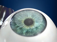 Levantamiento flap por la bisagra