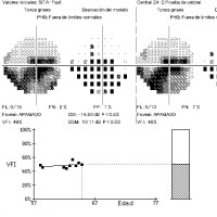 Campimetria-estudio-campo-visual-prueba-medica-oftalnova-barcelona-1-200x200