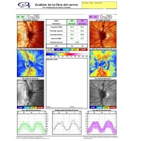 GDx-PRUEBA-MEDIC-OFTALMOLOGIA-OFTALNOVA-BARCELONA-200x200