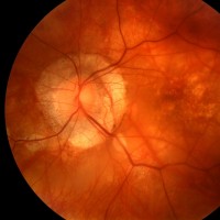 Angiografia-Fluoresceinica-Pruebas-oftalmologicas-Oftalnova-Barcelona-200x200