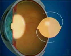 Oftalnova_Barcelona_soluciones_vista_cansada_lentes_intraoculares