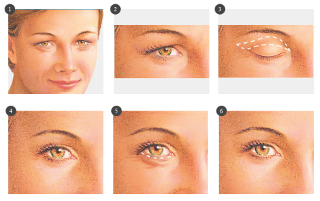 Blefaroplastia