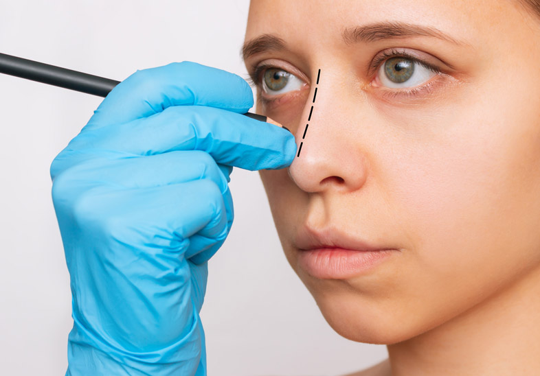 Rinoplastia