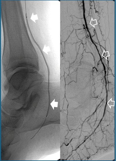 Tratamientos de revascularizacion