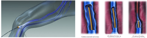Láser o radiofrecuencia