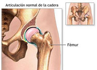 Fracturas de acetábulo