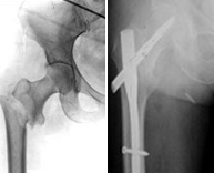 Fracturas de tercio superior del fémur