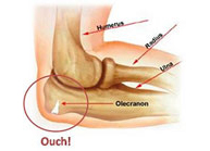 Fracturas de olécranon