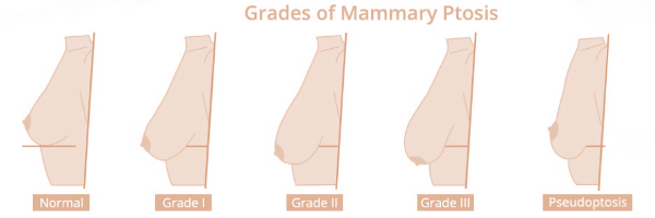 grados-ptosis-instituto-dra-ana-torres-barcelona