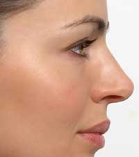 Rinoplastia