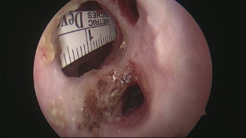 Perforación septal