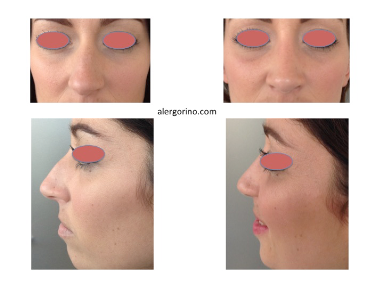 Rinoplastia centro medico teknon