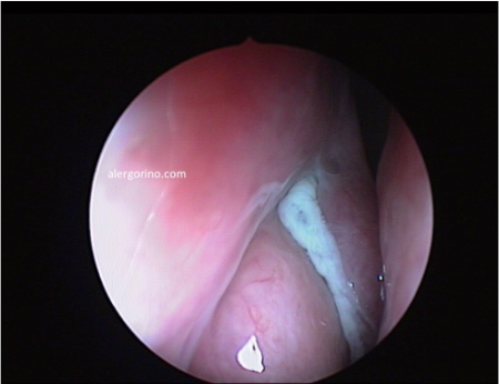 endoscopia nasal
