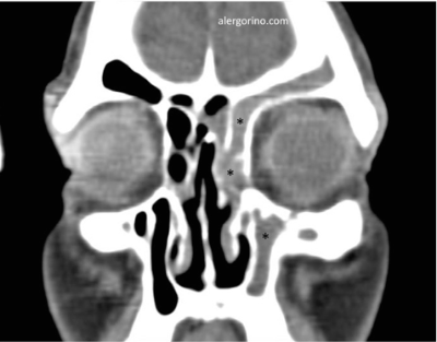 tomografía computarizada sinusitis