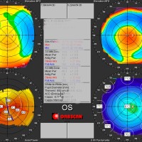 TOPOGRFIA-CORNEAL-ORBSCAN-Prueba-oftalmologia-Oftalnova-Barcelona