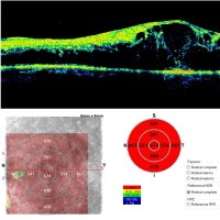 OCT-macula-prueba-medica-oftalmologia-oftalnova-barcelona