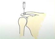 Infiltración de la articulación acromioclavicular