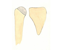 Figura 1. Prótesis humeral de superficie