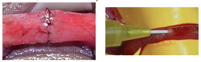 Muco-mucosa vasovasostomía