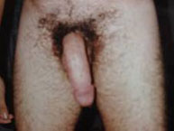 2. Incurvación congénita de pene, frontal