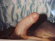 Enfermedad de Peyronie