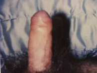 Enfermedad de Peyronie