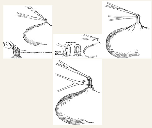 Disección de los vasos y túnicas deferenciales.