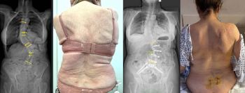 escoliosis degenerativa dorsolumbar severa