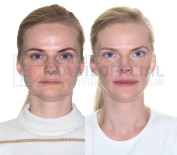 cirugía estética belleza Teknon