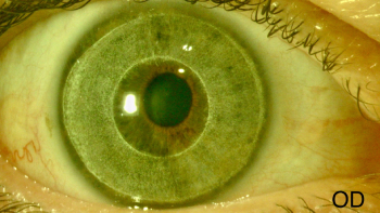 Prequirurgico ojo derecho_Dr. Castanera_CM Teknon