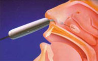 obstruccion-nasal-2