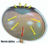 Glaucoma