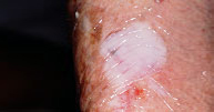 Oclusión del carcinoma