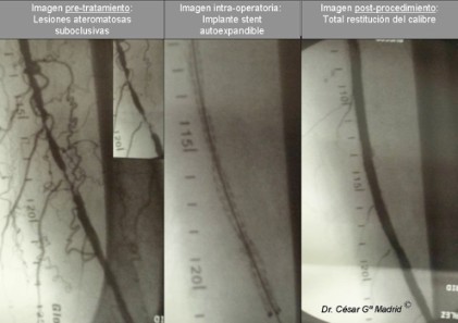 tratamiento by pass úlceras dr cesar garcia madrid