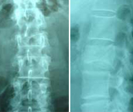 Cifoplastia_05