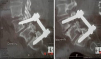 Implante percutáneo a través de cuatro incisiones de sólo 1 cm, sin cirugía abierta