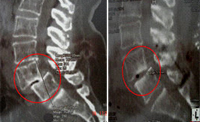 implantes4