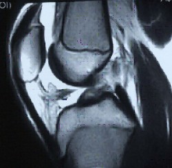 Lesiones ligamentosas