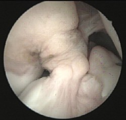 Lesiones ligamentosas