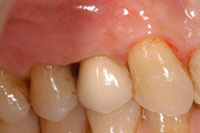 Implantes