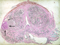 cancer de prostata