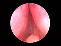 ablacion prostatica