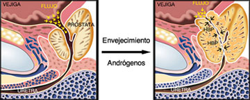 enfermedades de prostatsa