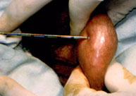 Biopsia con aguja a ciegas